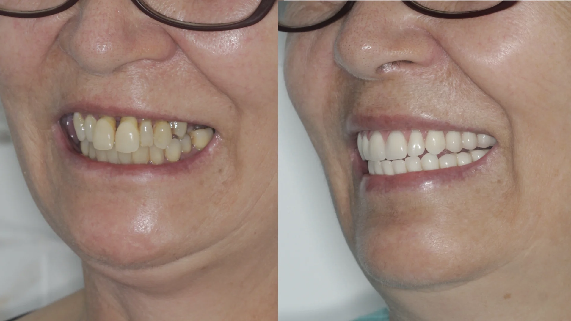 Dr. André Godoy Implantes dentário Allonfour AO4