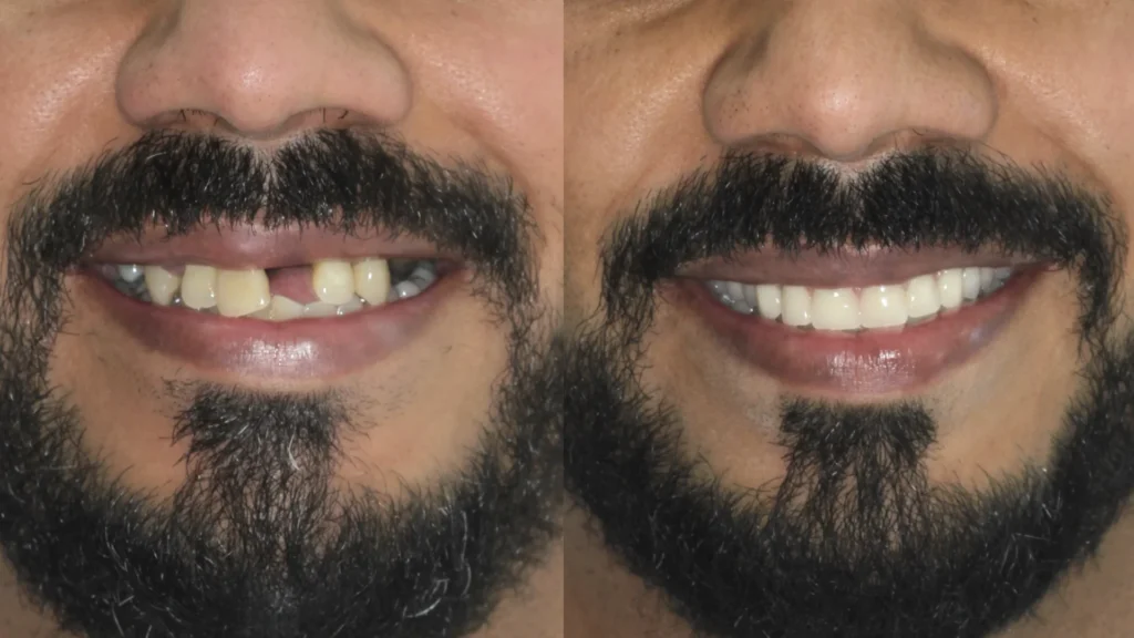 Dr. André Godoy Implantes dentário Allonfour AO4