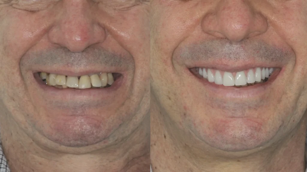 Dr. André Godoy Implantes dentário Allonfour AO4