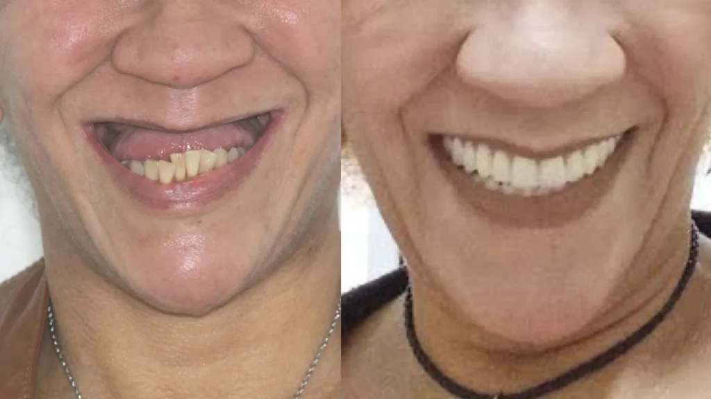 Implantes dentário Allonfour AO4