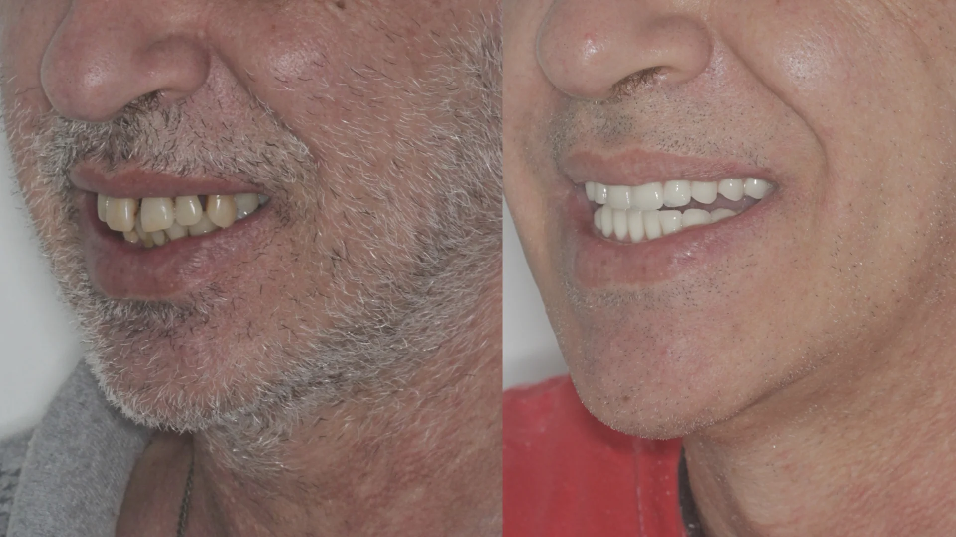 Dr. André Godoy Implantes dentário Allonfour AO4