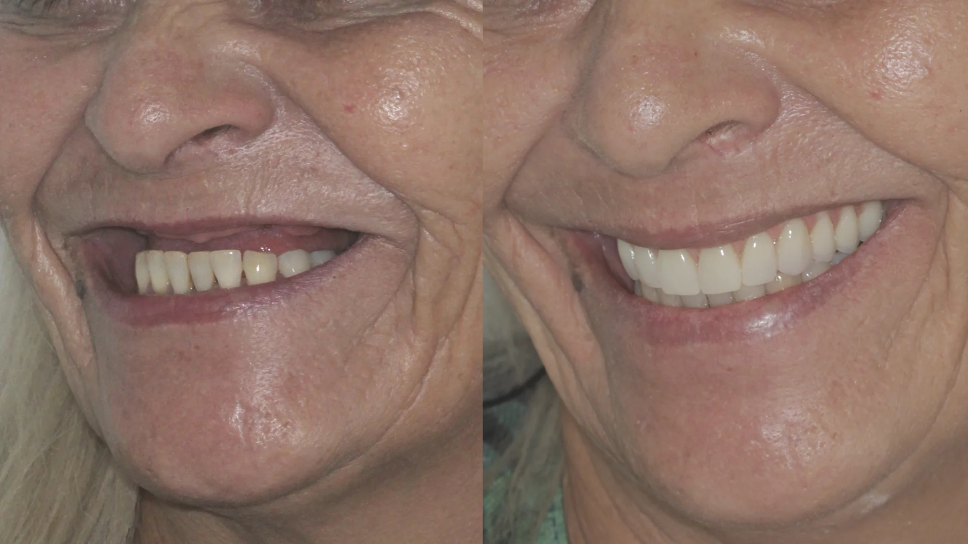 Dr. André Godoy Implantes dentário Allonfour AO4