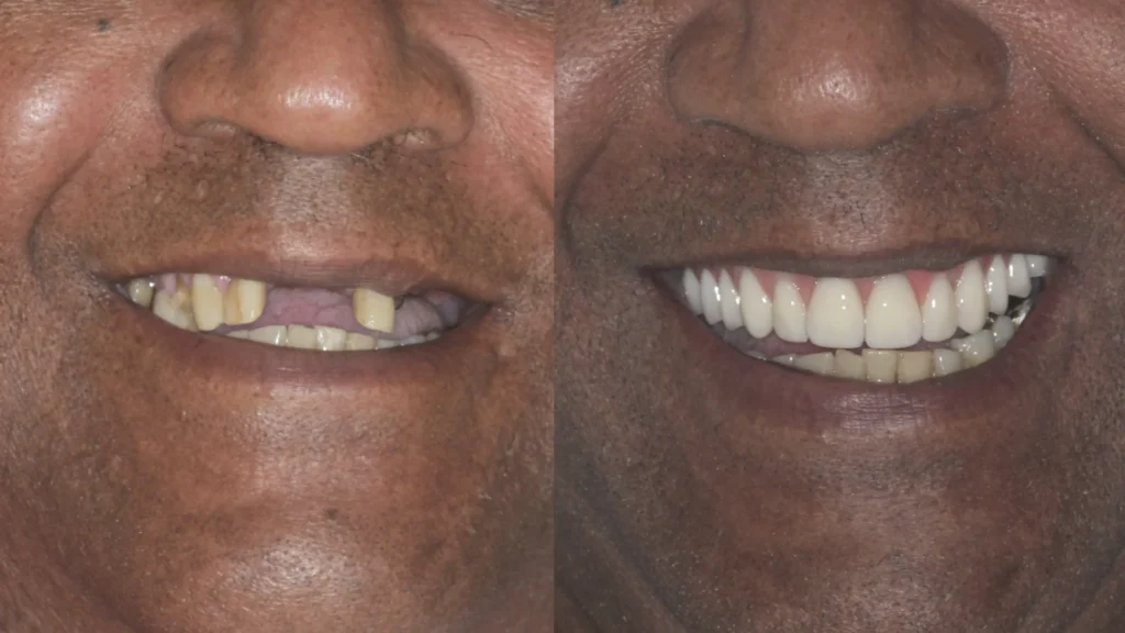 Dr. André Godoy Implantes dentário Allonfour AO4