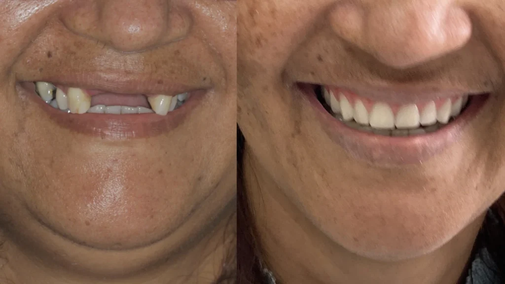 Dr. André Godoy Implantes dentário Allonfour AO4